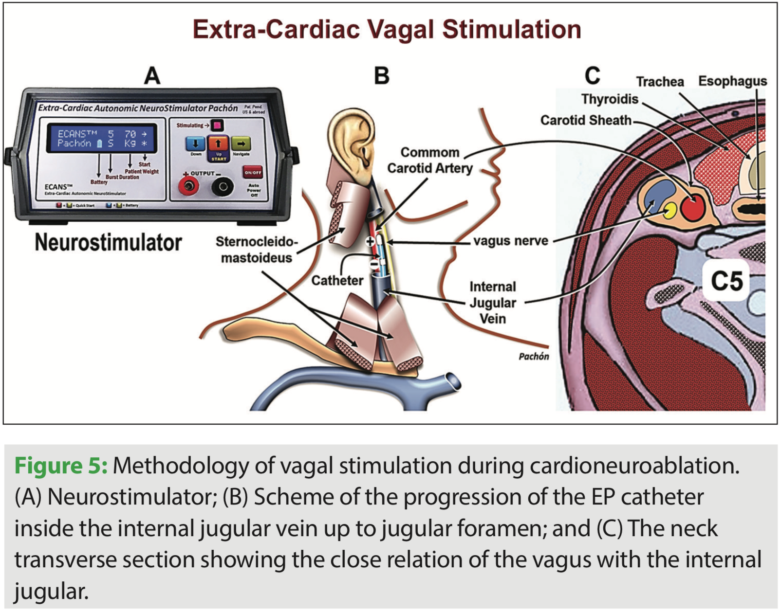 Cardioneuroablation Cardiac RF Catheter Vagal Denervation Concept, Method, and Results